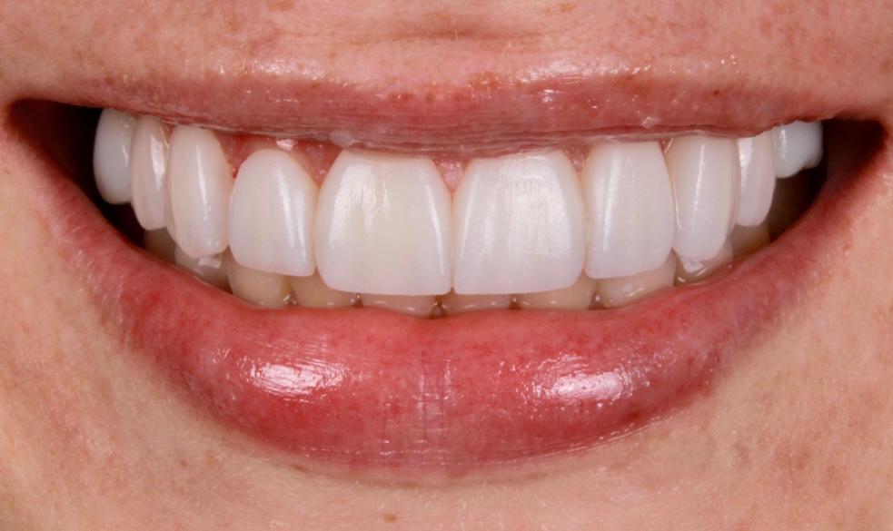 Después diseño dental